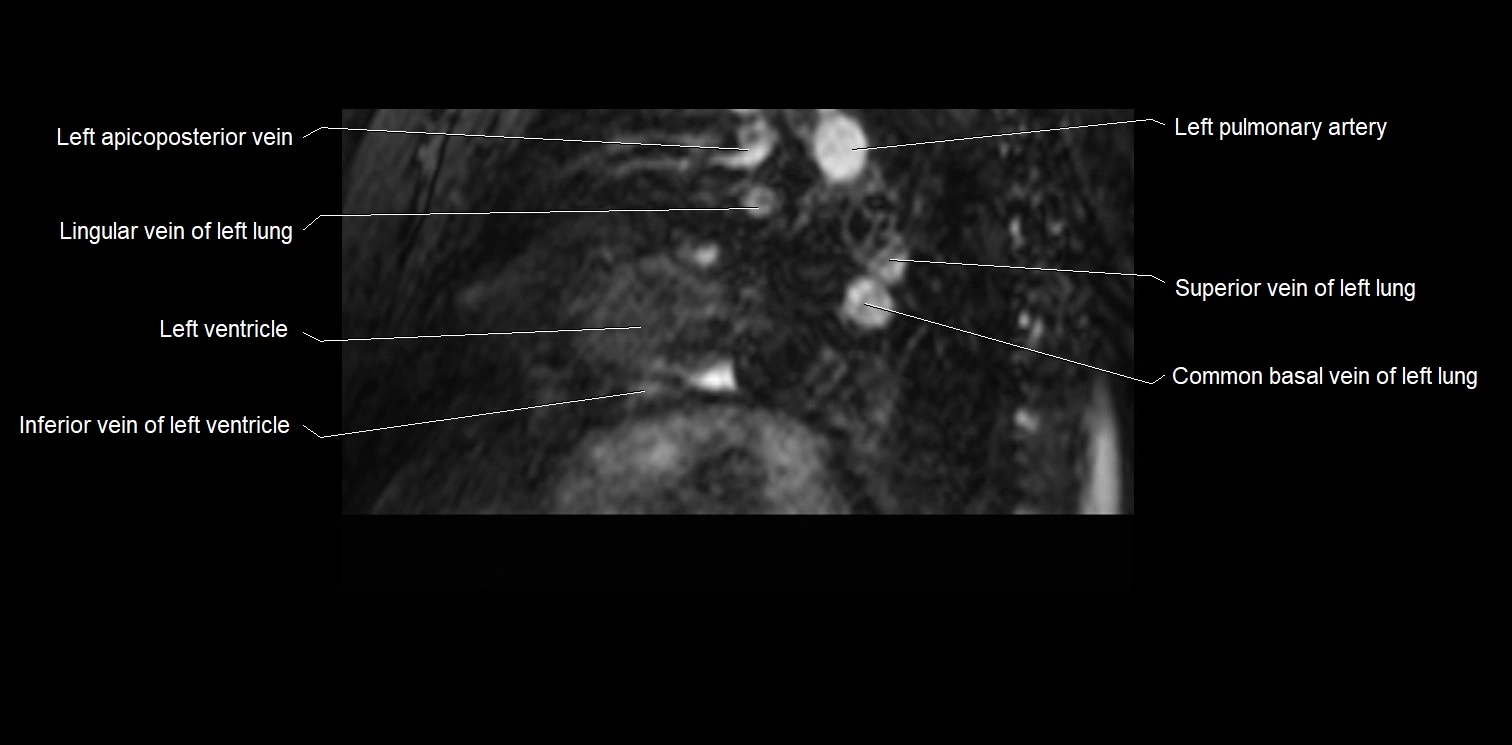MRI heart and coronary arteries two chamber(sagittal)  anatomy image 38.webp